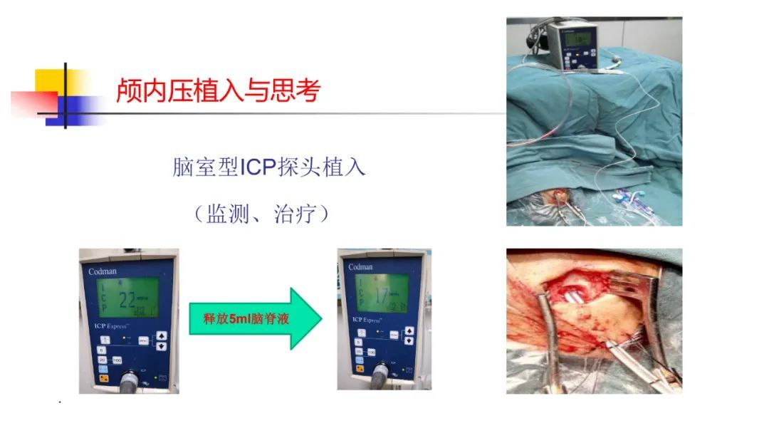监测有道丨颅内压监测下多发脑挫伤的救治一例——颅脑创伤-神经重症