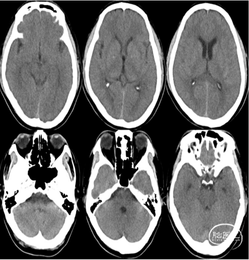 头颅ct提示蛛网膜下腔出血.