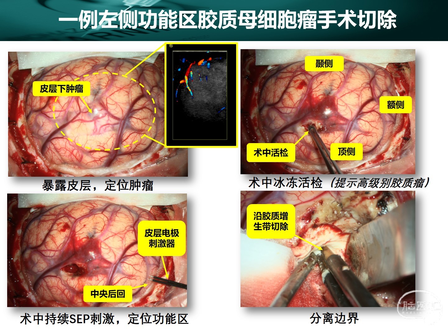 西安交通大学第一附属医院王拓教授团队一例左侧功能区胶质母细胞瘤