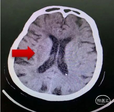 入院ct提示右侧基底节低密度灶.