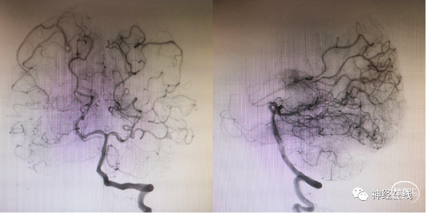 烟雾病相关性动脉瘤一例