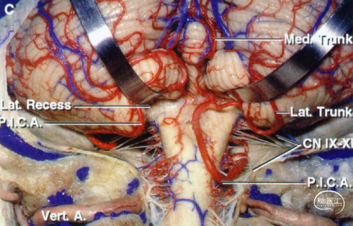 两侧小脑扁桃体之间的小脑谷结构