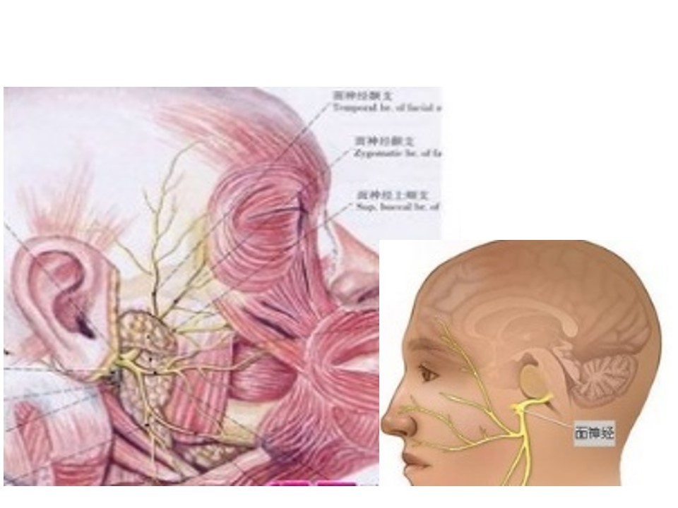 面肌痉挛治疗新技术-ct引导下茎乳孔面神经射频