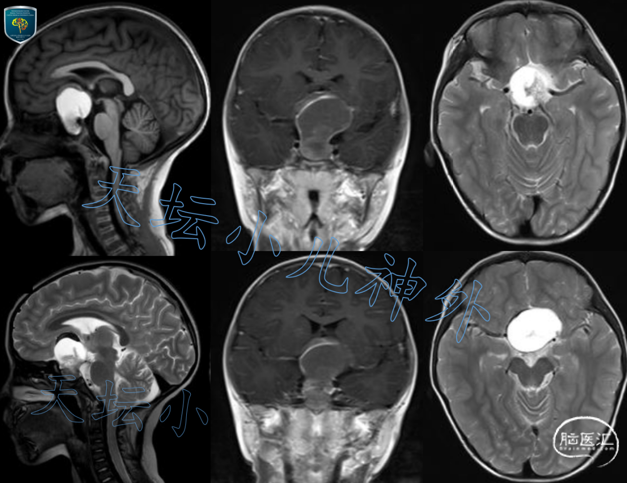 贺晓生教授小脑幕上下骑跨脑膜瘤的外科切除手术案例 - 微医（挂号网）