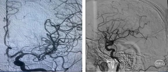 前明显吸收,予欣维宁静滴,亚宁定控制性降压,加用倍清星改善神经功能
