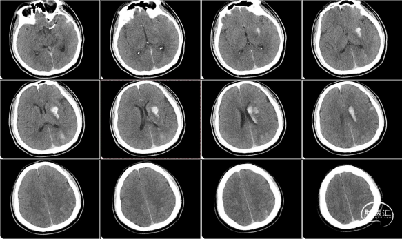 前明显吸收,予欣维宁静滴,亚宁定控制性降压,加用倍清星改善神经功能