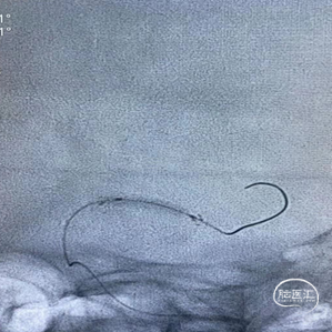前明显吸收,予欣维宁静滴,亚宁定控制性降压,加用倍清星改善神经功能