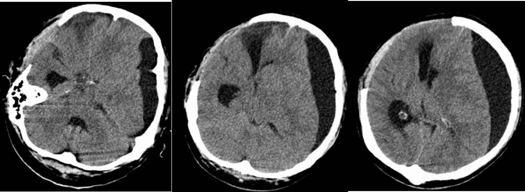 (dc术后19天)头颅ct提示:左侧硬膜下积液较前明显增多,轻度脑膜脑膨出
