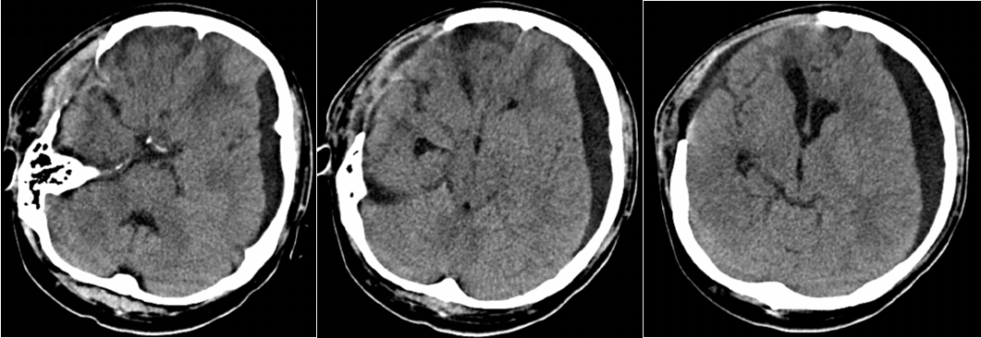 去骨瓣减压术后继发硬膜下积液合并脑积水一例附浙二诊疗流程神经急