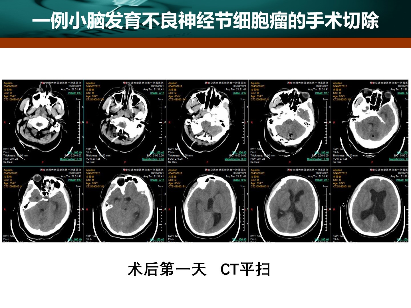 西安交通大学第一附属医院王拓教授团队一例小脑发育不良神经节细胞瘤