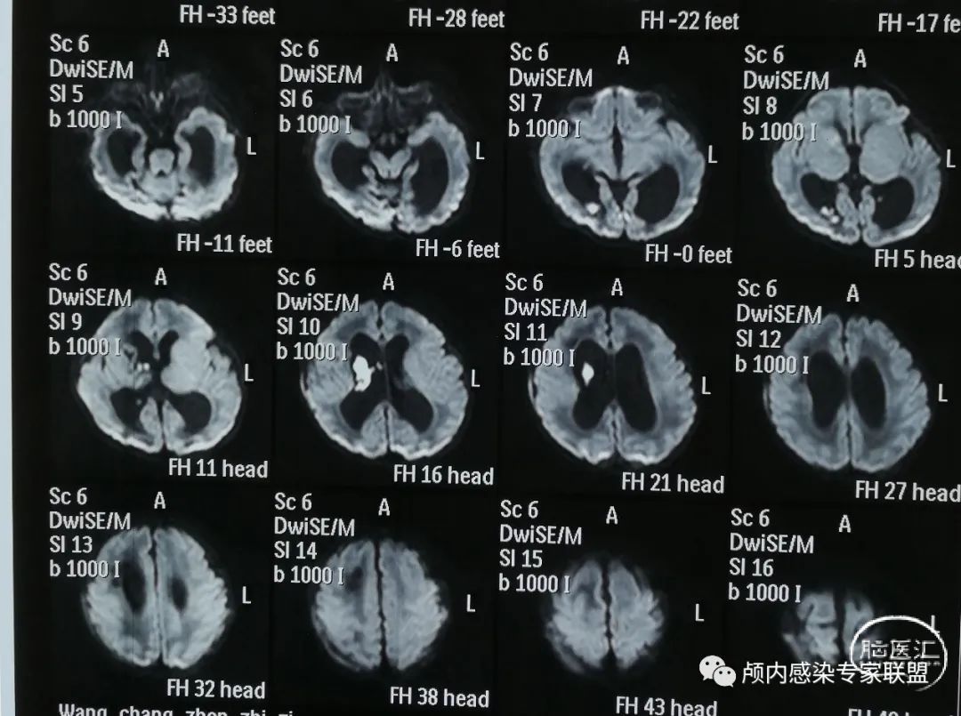 一名蒙古国脑积水患者在李小勇脑脊液中心完成手术 - 知乎