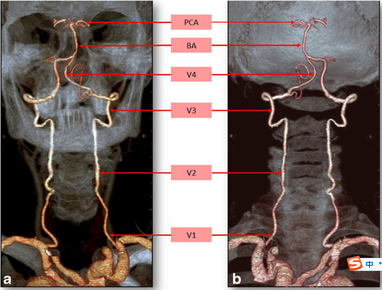 椎动脉(vas)通常起源于锁骨下动脉(偶尔直接发自主动脉弓),并通过颈椎