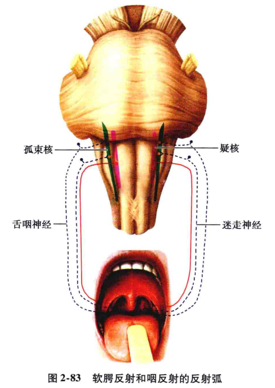 表现为声音嘶哑,饮水呛咳,吞咽困难,病灶同侧软腭麻痹(下垂),悬雍垂